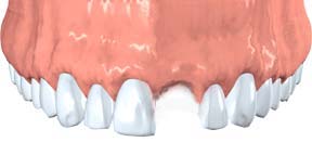 Avulsed Teeth, Knocked-Out Teeth, Endodontics