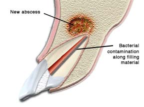 Reasons for Endodontic Retreatment