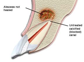 Reasons for Endodontic Retreatment