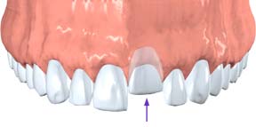 Dislodged Teeth, Endodontics