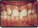 Missing Teeth before photo