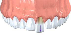 Dislodged Teeth, Endodontics
